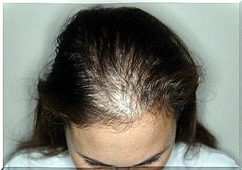 Alopecia Areata