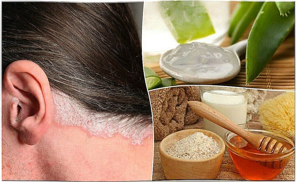 5 Home Remedies For Scalp Psoriasis