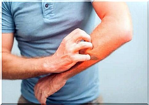 5 Natural Remedies To Relieve Itching