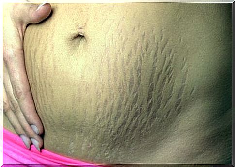 belly with stretch marks