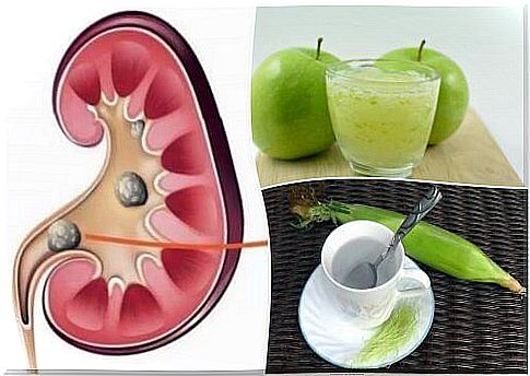 Break down kidney stones with these natural remedies