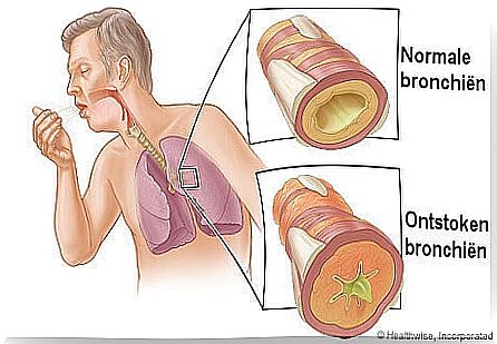 chronical bronchitis