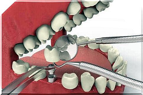 Dental implants