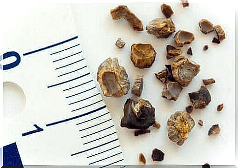 Kidney stones next to a ruler