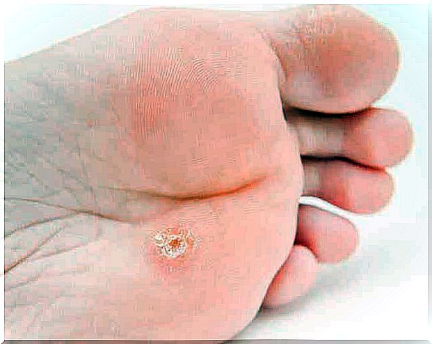 Warts usually disappear on their own