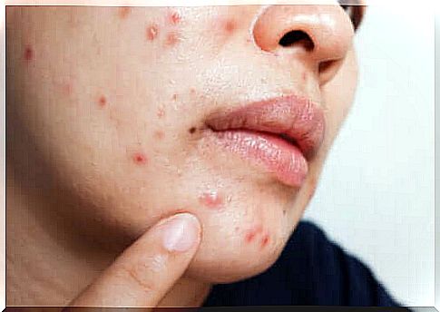 Isotretinoin For Acne: Benefits And Side Effects