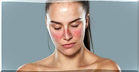 Woman with a rash on her face