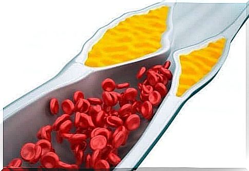 Constriction by cholesterol