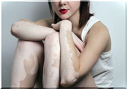 Woman with vitiligo