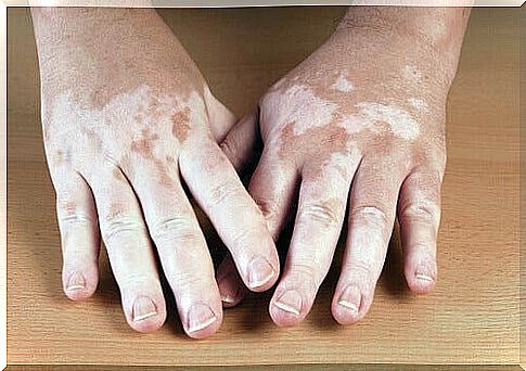 Vitiligo remedies