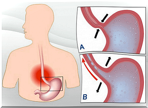 Remedies To Treat Heartburn