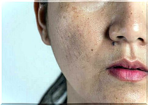 Woman with facial skin changes