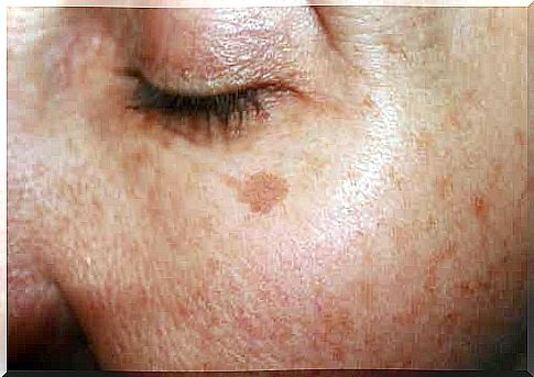 A woman with spots on her skin