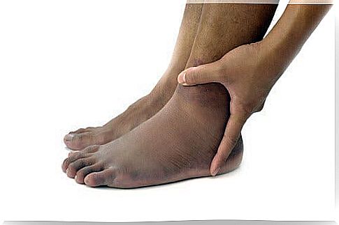 Swollen ankles or feet due to insufficient functioning of the veins