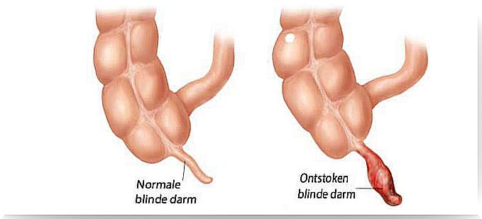 Appendicitis