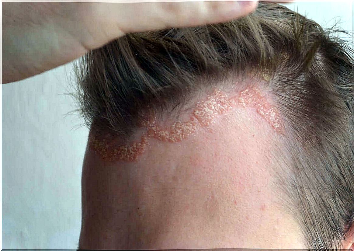 Scalp with psoriasis