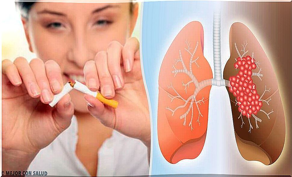 The Causes and Diagnosis of Lung Cancer