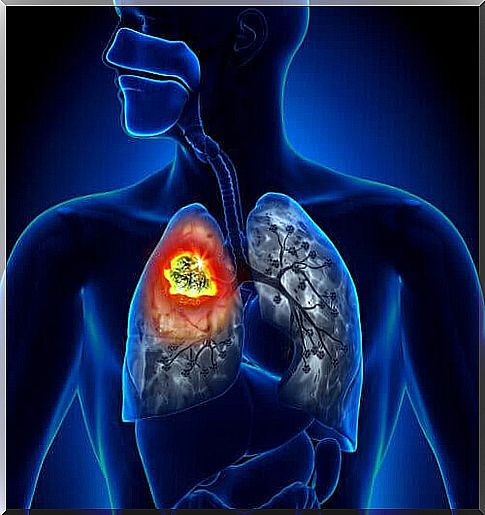 Types of Lung Cancer