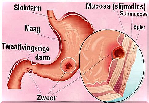 Treating a stomach ulcer naturally