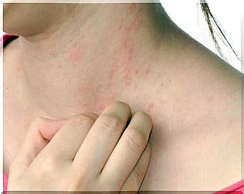 Woman scratches eczema